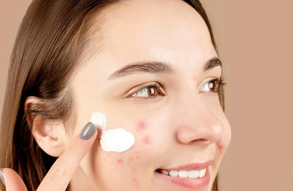 8 Effective Ways to Get Rid of Acne Marks Naturally