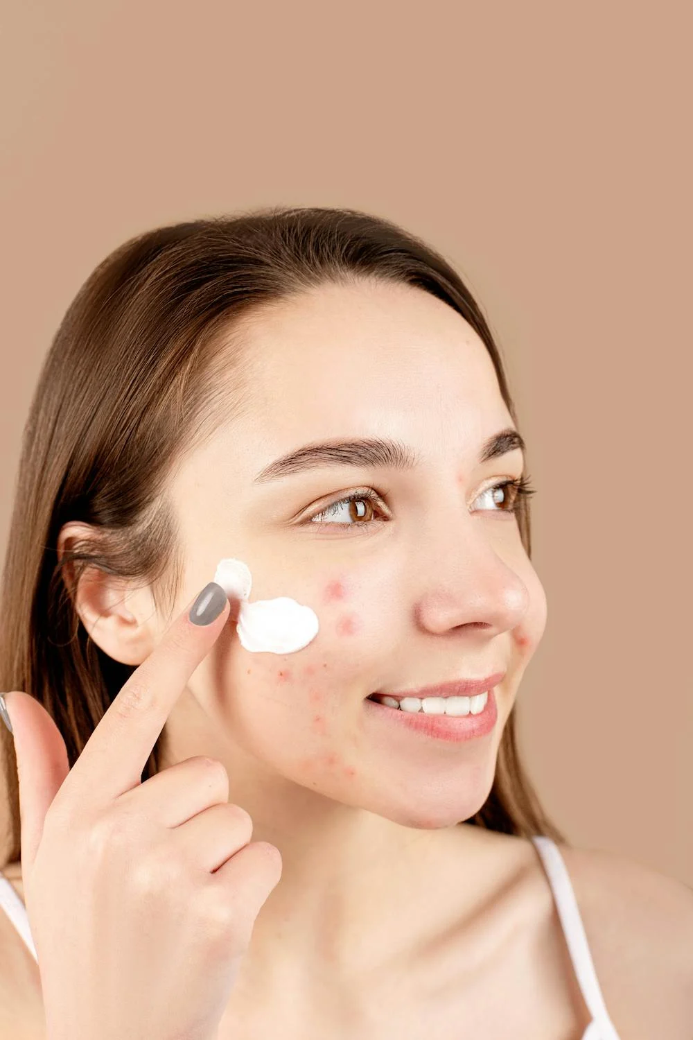 Acne Marks