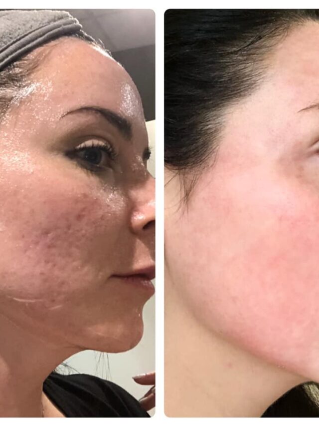 CO2 Laser Skin Resurfacing: The Ultimate Skin Transformation